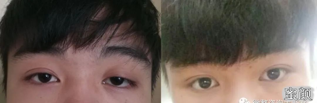 【美然】眼眸之美变--如何做得好看自然的双眼皮 整形科双眼皮手术