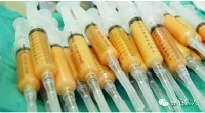 自体脂肪确实会比直接注射玻尿酸要麻烦一点,但是自体脂肪来源于