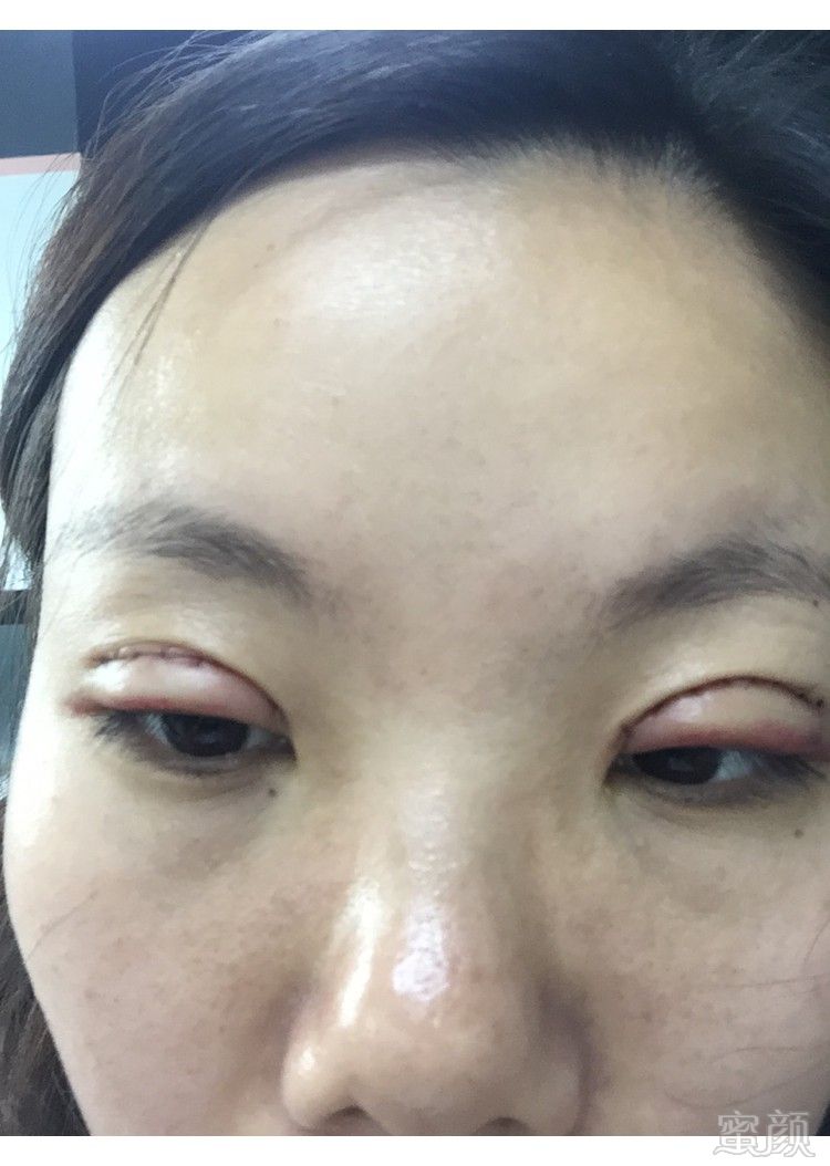 重庆好美医疗美容门诊部割双眼皮案例和效果图:第一天