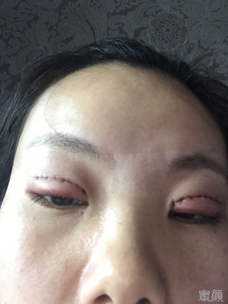 重庆好美医疗美容门诊部割双眼皮案例和效果图:第一天