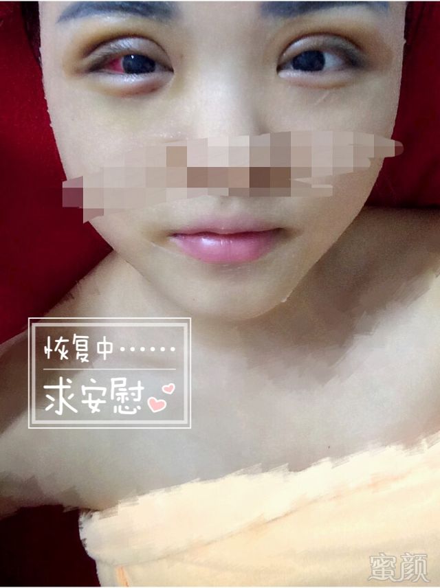 深圳流花医院整形科割双眼皮案例和效果图:做的韩式三