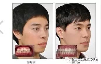 牙齿矫正能改变脸型吗?
