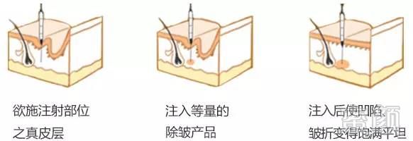 除皱针 注射除皱原理     医生解析:除皱针利用生物活性物质注射在