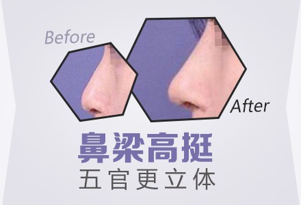 耳软骨垫鼻尖 综合隆鼻一步到位打造完美鼻型