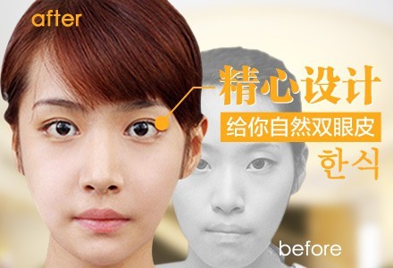 北京肌脸定位双眼皮-