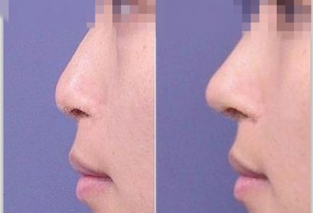 韩式硅胶假体隆鼻+耳软骨垫鼻尖 打造芭比美鼻