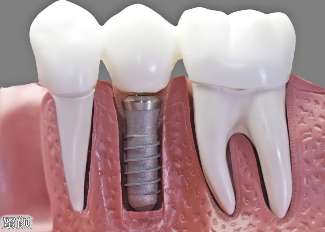 医生解答种植全口牙有哪些类型 蜜颜整形优惠