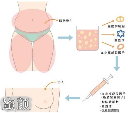 注射隆胸手术需要注意些什么呢 蜜颜整形优惠