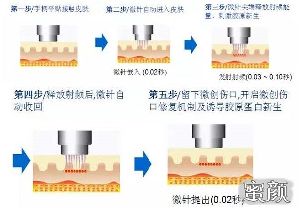 韩国整形美容医院微针除皱还你年轻容颜 蜜颜整形优惠