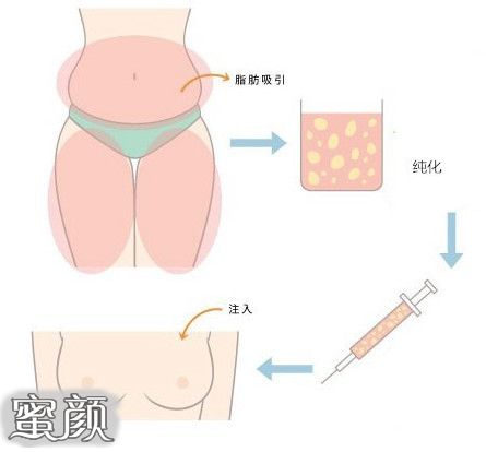 自体脂肪注射填充 抗衰神器的深入探索丨科普篇 蜜颜整形优惠