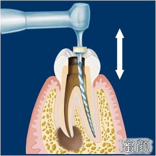 「牙醫學堂」根管治療後牙齒直接樹脂修復的操作流程