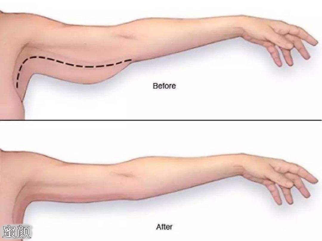 手臂抽脂（蝴蝶袖） | 安瑟整形外科診所