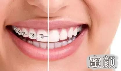 做牙齿矫正 牙套上挂橡皮筋的作用及多久换一次可得清楚 蜜颜优惠