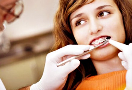 美年口腔 陶瓷托槽牙齿矫正套餐 全程矫正 贴近天然色牙齿