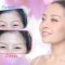 进口肉毒素消灭抬头纹 摆脱额头皱纹 重拾青春