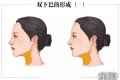 想要摆脱双下巴烦恼？了解下巴溶脂手术的安全与效果！
