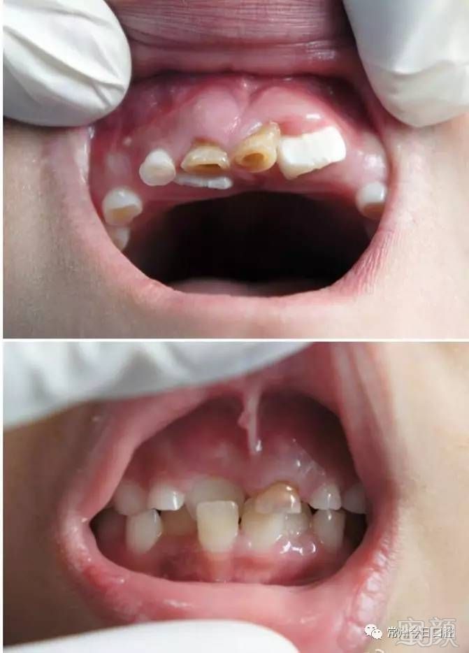 小孩吸奶嘴牙齿变形图图片