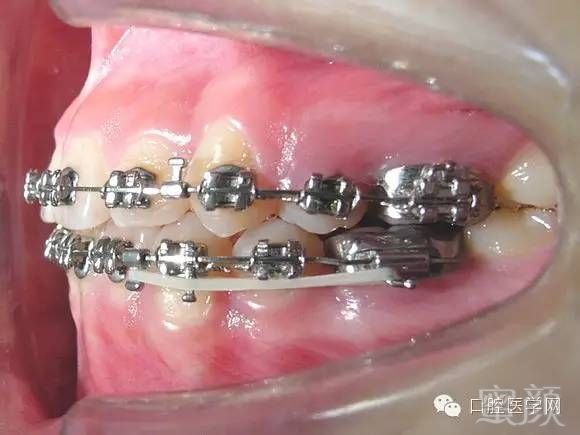 牙齿矫正知识科普帖正畸牙套装置部件详解附图片