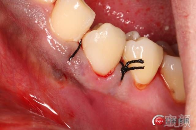 分享一组双尖牙根面龋补牙案例