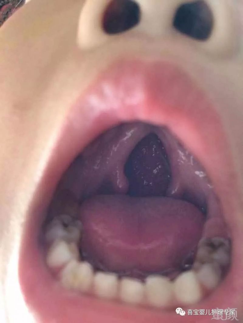 婴儿口腔软腭裂图片图片
