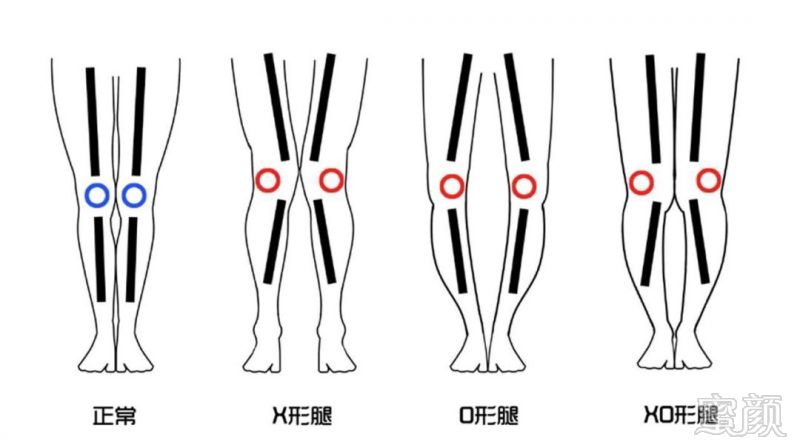 关于o型腿矫正问题汇总