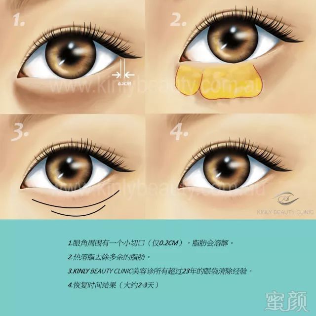 https://img.miyanlife.com/mnt/timg/180223/112K535B-7.jpg