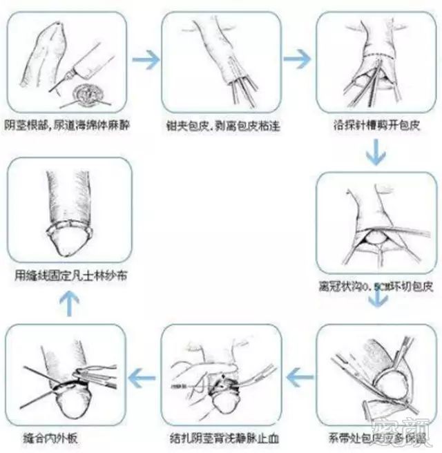 系带横切纵缝手术图解图片