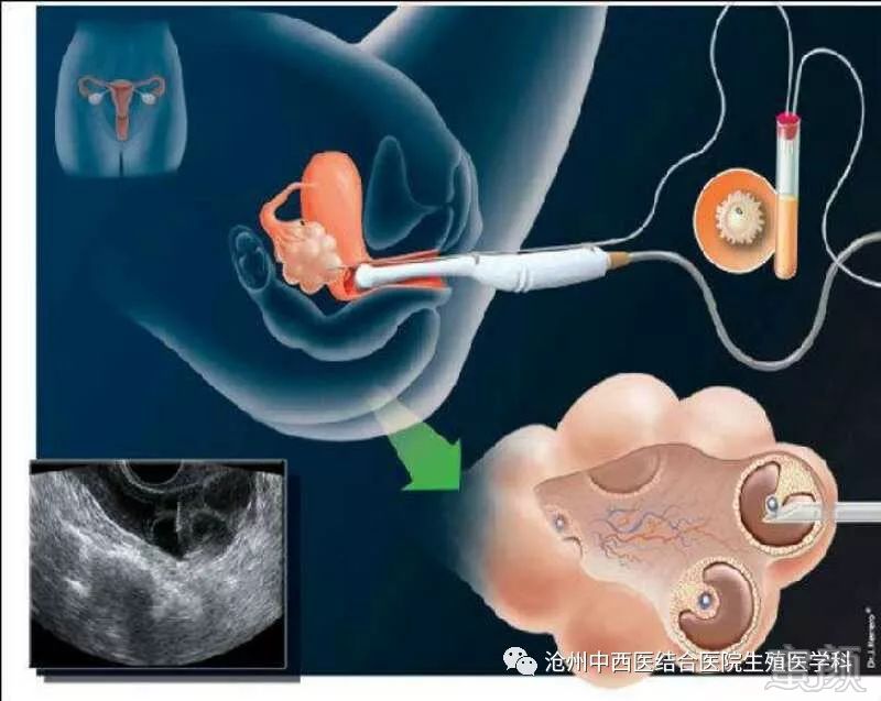 超越标准 人工受精都要准备什么"粗制滥造-第2张图片-助北网