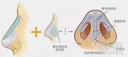 2,鼻中隔软骨