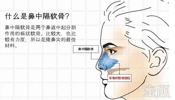 鼻尖塑形,耳软骨和鼻中隔软骨哪个更好?