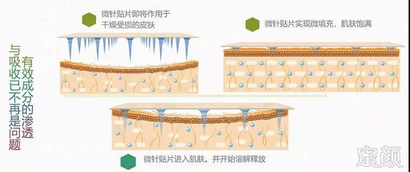 透皮微针眼贴将皮肤本身就存在的成分—玻尿酸,制成微米级的细小微针