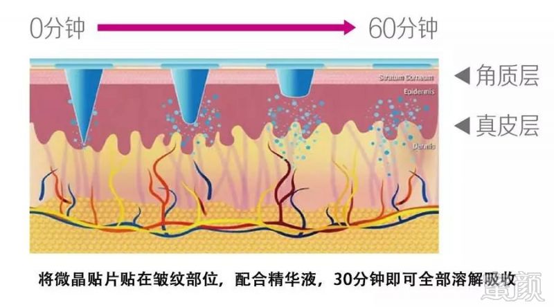 了解国际蕞先进微针经皮给药技术微针眼贴的工作原理