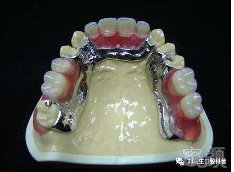 适宜于全口多数牙缺失,余留牙少的情况,类型包括铸造支架,弹性义齿,锻