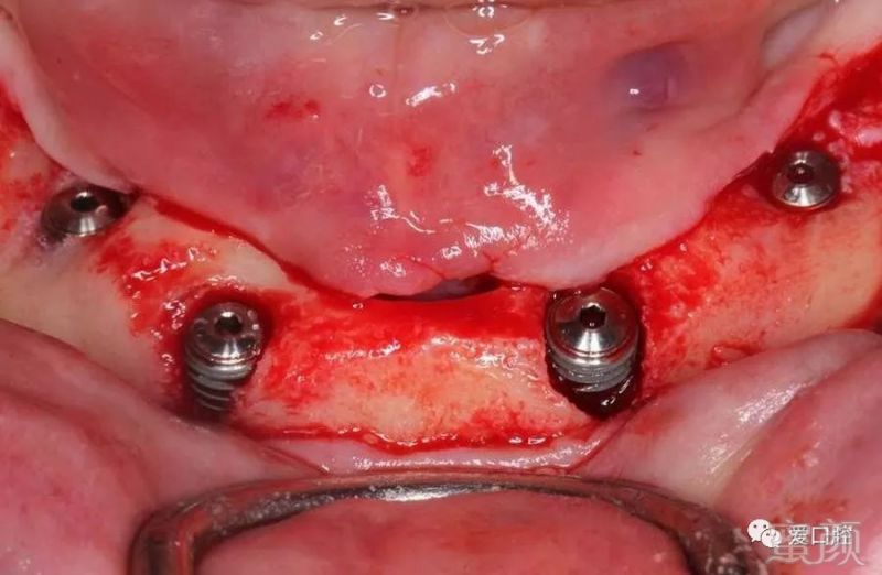 半口牙缺失:下颌all on 4种植牙病例