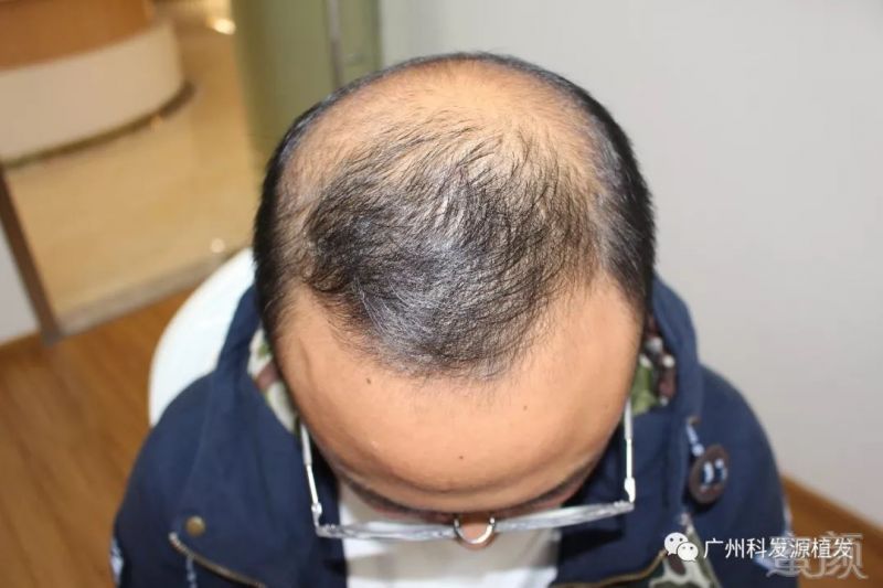 脱发10年,力求完美植发两次   一般有遗传性脱发基因的,到了30岁脱发