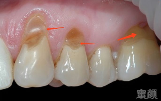 这 30 个牙齿问题,从半岁就该注意    牙隐裂     楔缺  楔状缺损和