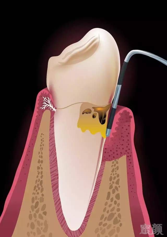 长时间的牙结石堆积最后会造成牙槽骨吸收和牙周袋形成,牙周袋内很