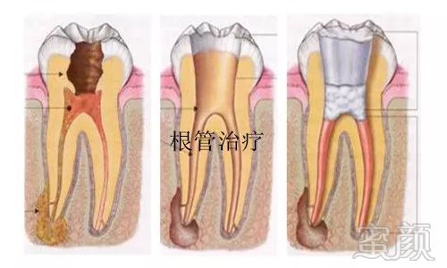 根管治疗会 杀神经 做不得 南方医科大学口腔医院