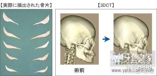 技术贴 图文介绍日本的小脸手术 垫下巴 双眼皮 蜜颜整形优惠