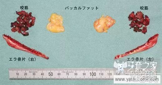技术贴 图文介绍日本的小脸手术 垫下巴 双眼皮 蜜颜整形优惠