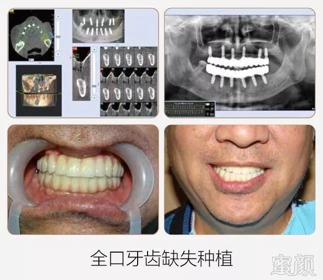 门牙严重缺损无牙根能否种植？