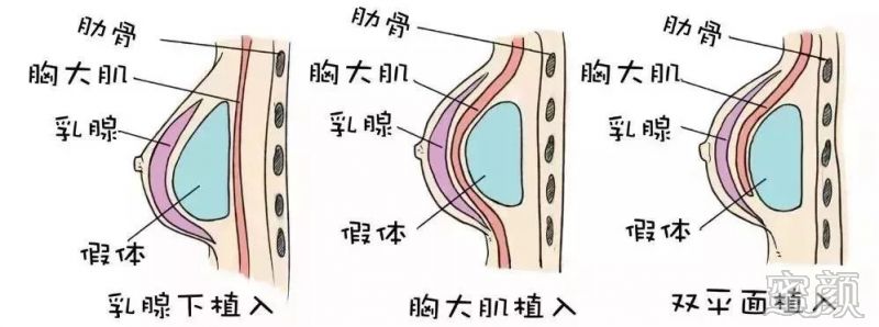 选择假体隆胸一般放置的位置 人字乳沟 打造乳房zui佳弧度值 呈现
