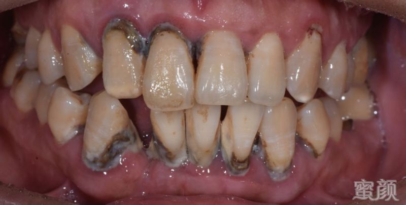 牙齿已经要离你而去了,但是这时积极的治疗大部分牙齿还是可以保留住
