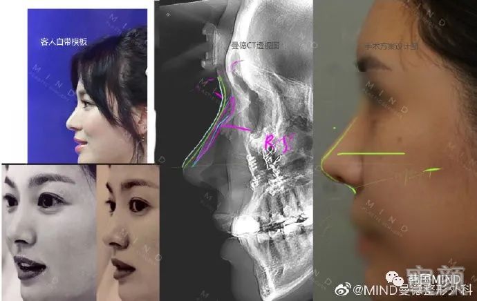 我是不是隆鼻失败了 隆鼻失败该怎么办 蜜颜整形优惠