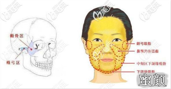 颧骨内推是什么原理图片