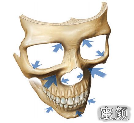 "面部骨骼吸收的一般后果是什么?骨膜退缩,改变骨骼外表面的位置.