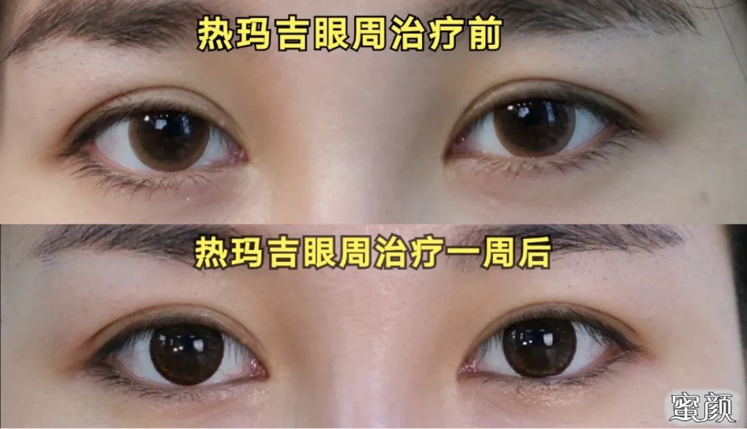 眼睛肿了用热水还是冷水敷 生活常识 养乐谷