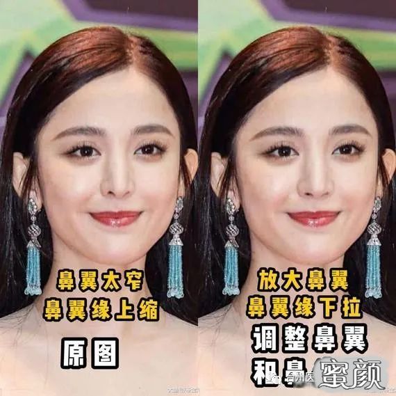 反之鼻孔大小适当和鼻孔小就很不适合缩鼻翼,更适合抬高鼻头的方式