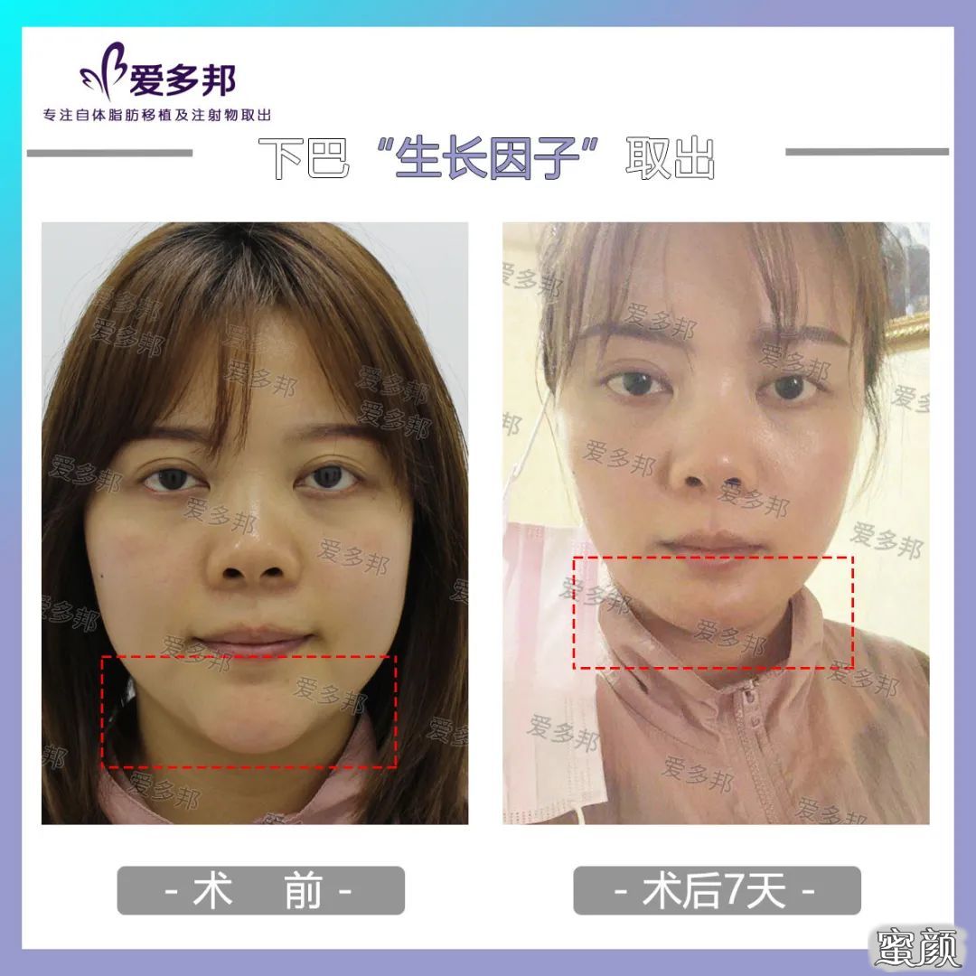 上海4月10日最划算的医美项目:8260起的假体下巴 娇俏下巴勾勒脸型-伴你美