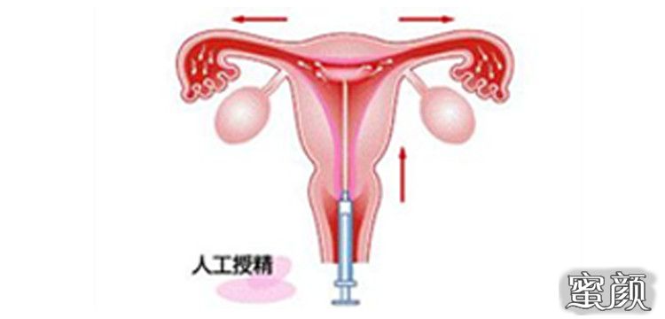 人工助孕方法郑州图片